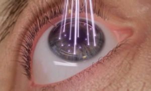 laser eye surgeroy