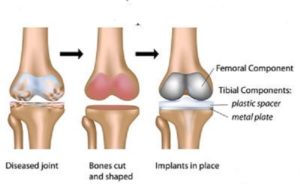 total-knee-replacement-surgery