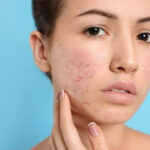 Buy Ultima-Accutane Online – Relief from Severe Acne Problems